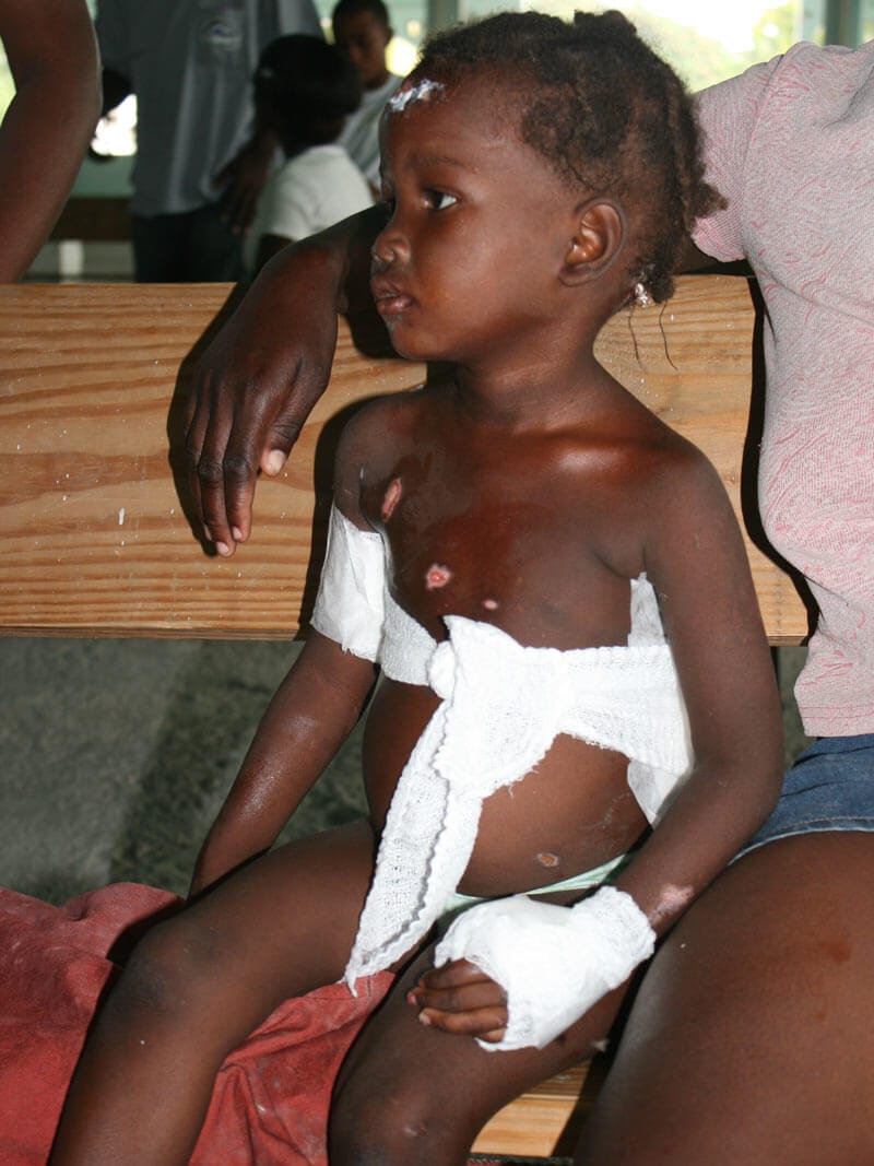young girl wounded by hurricane